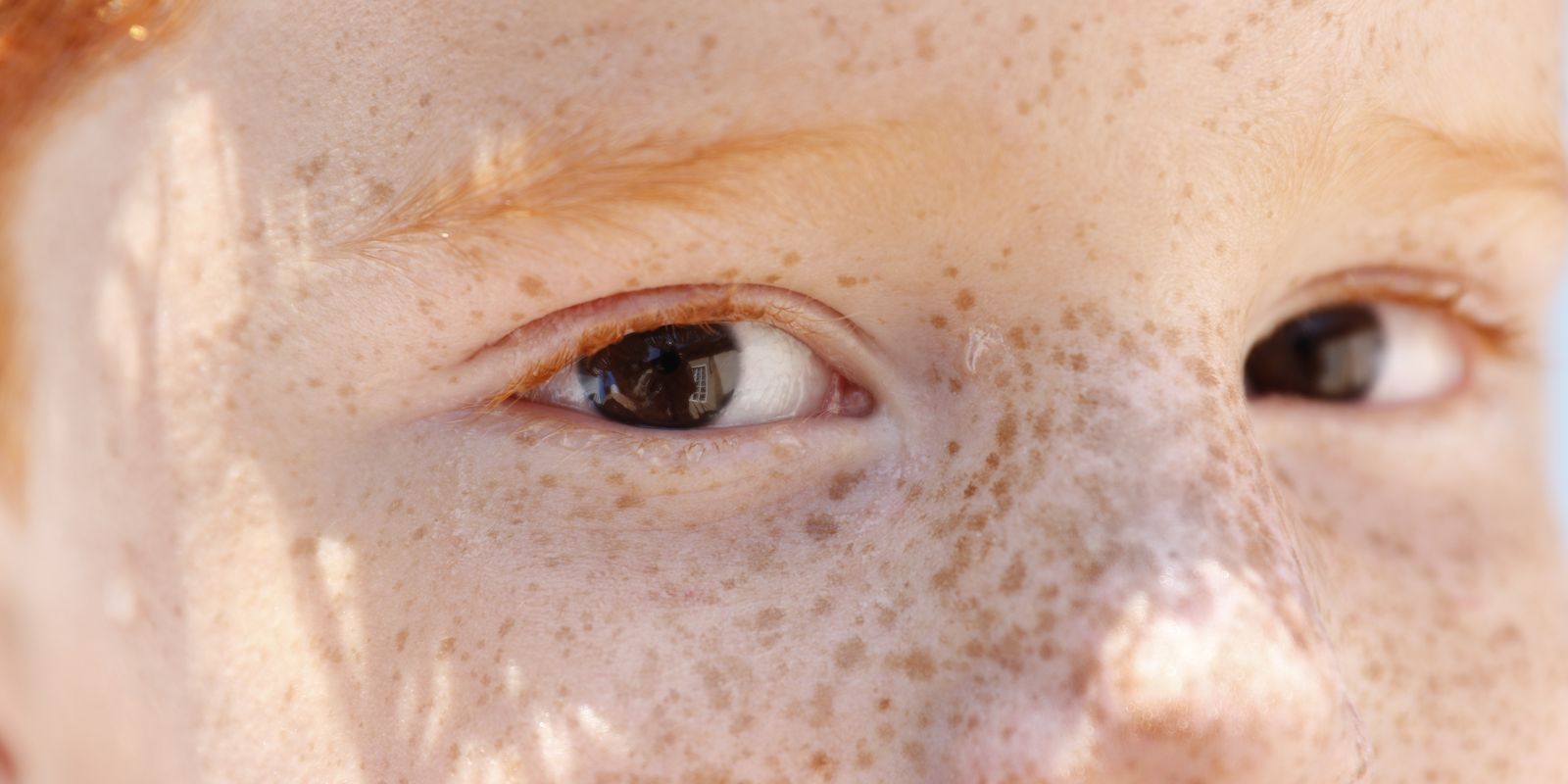 Reflexo branco nos olhos: entenda condição que assusta pais